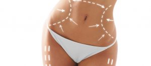 Carboxiterapia corporal