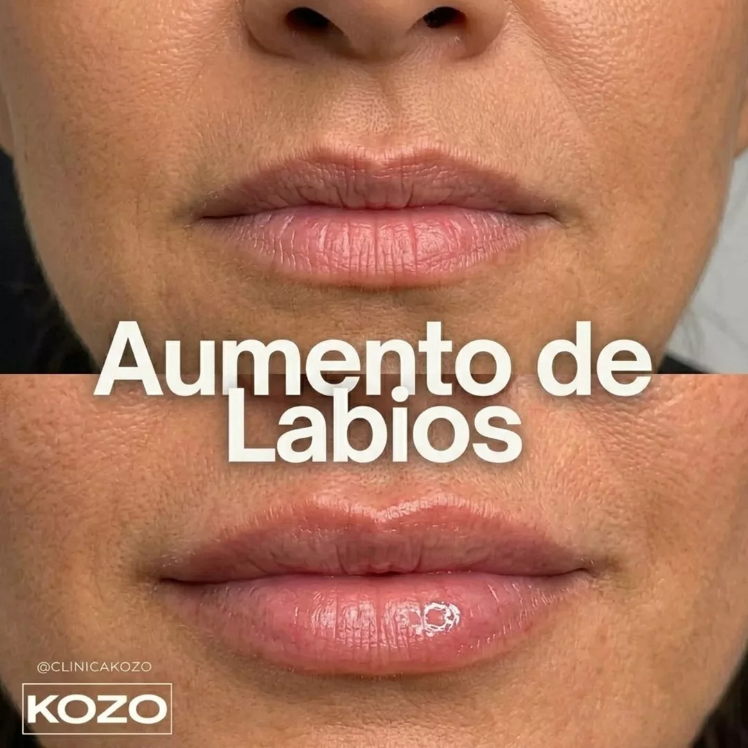 Aumento de labios con ácido hialurónico