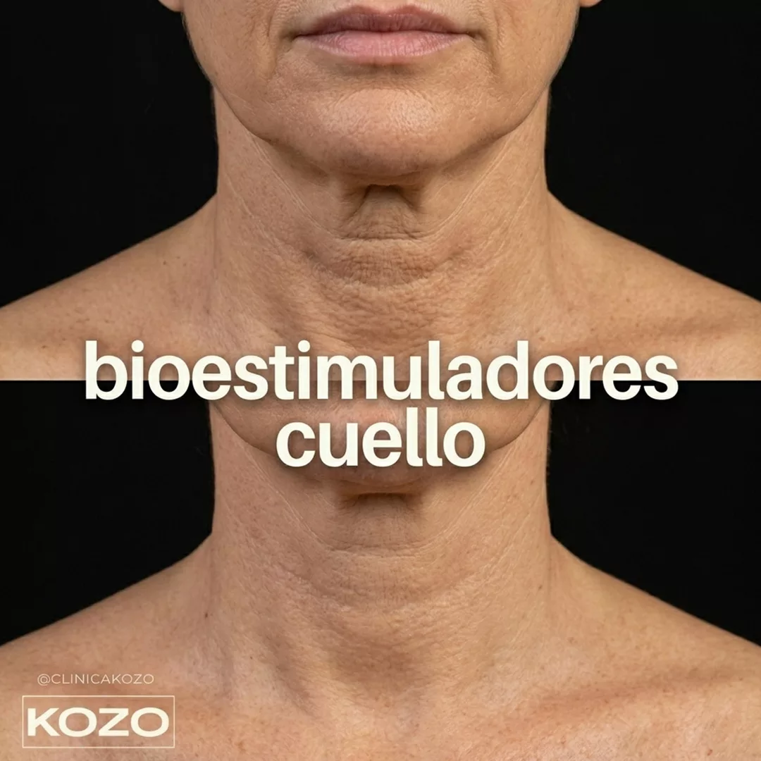 Rejuvenecimiento de cuello con bioestimuladores