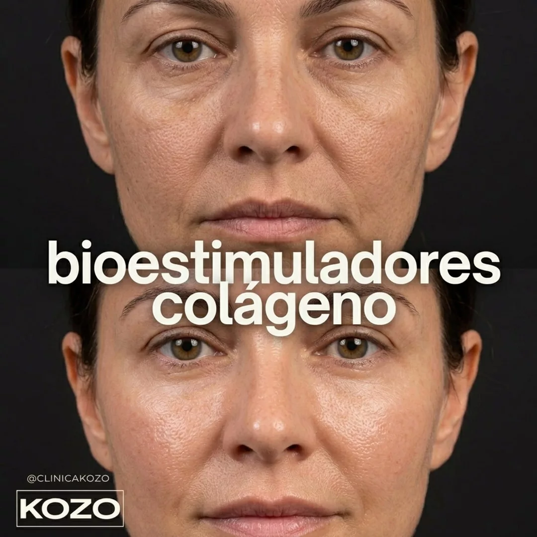 Bioestimuladores de colágeno para firmeza facial