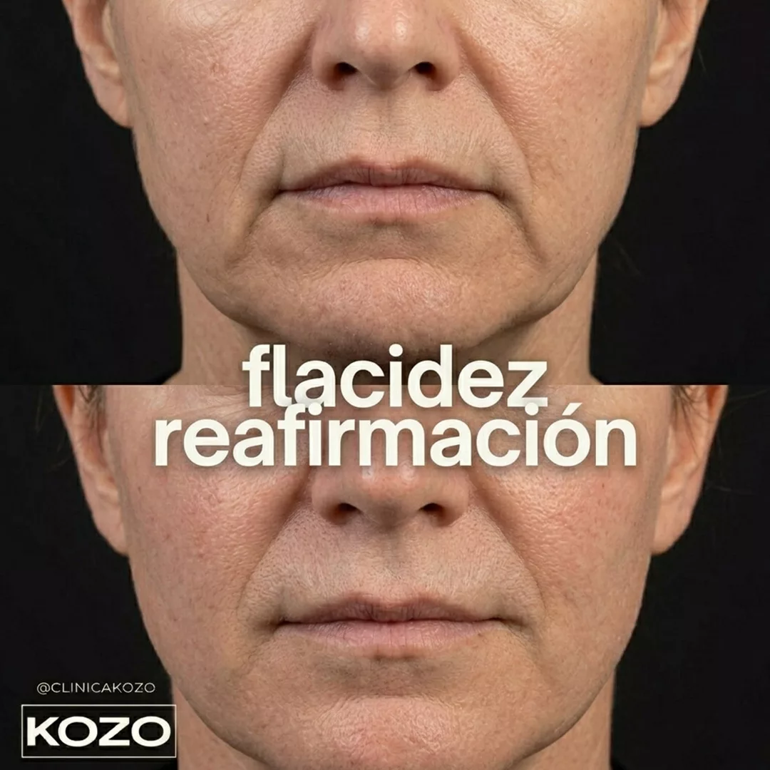 Tratamiento de reafirmación para flacidez facial