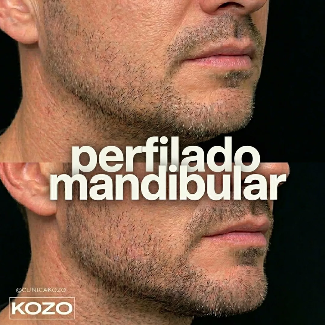 Definición del perfil mandibular con ácido hialurónico