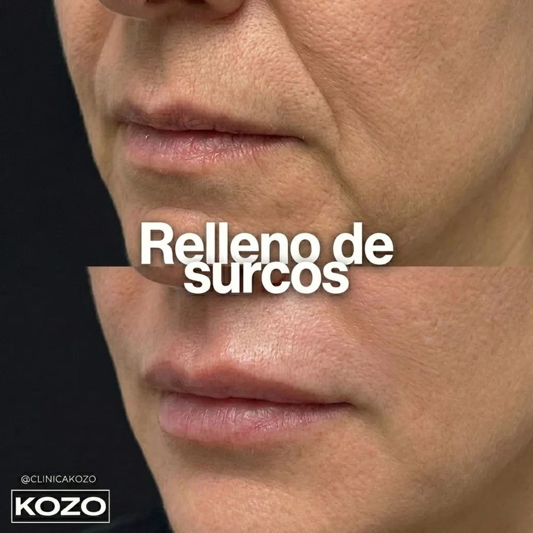 Relleno de surcos nasogenianos con ácido hialurónico