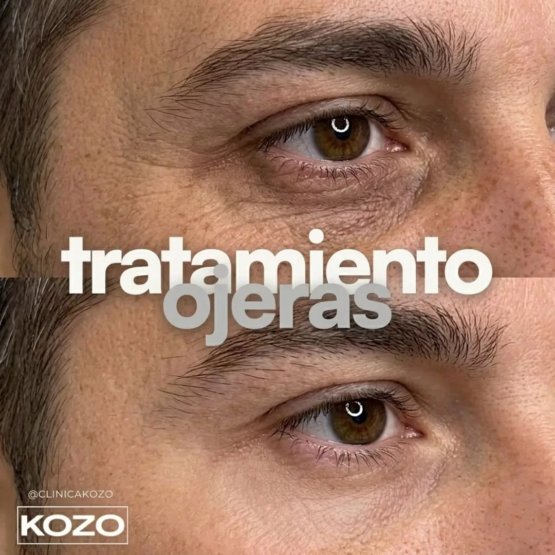 Tratamiento de ojeras con ácido hialurónico